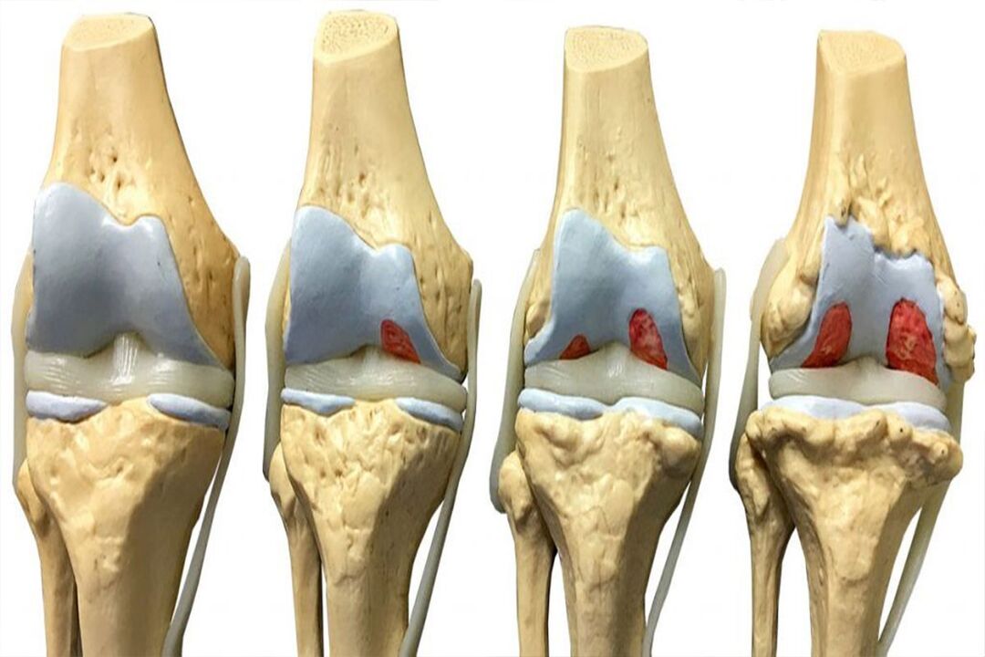 étapes du développement de l'arthrose