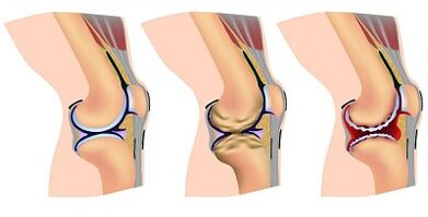 Phase de développement de l'arthrose de l'articulation du genou