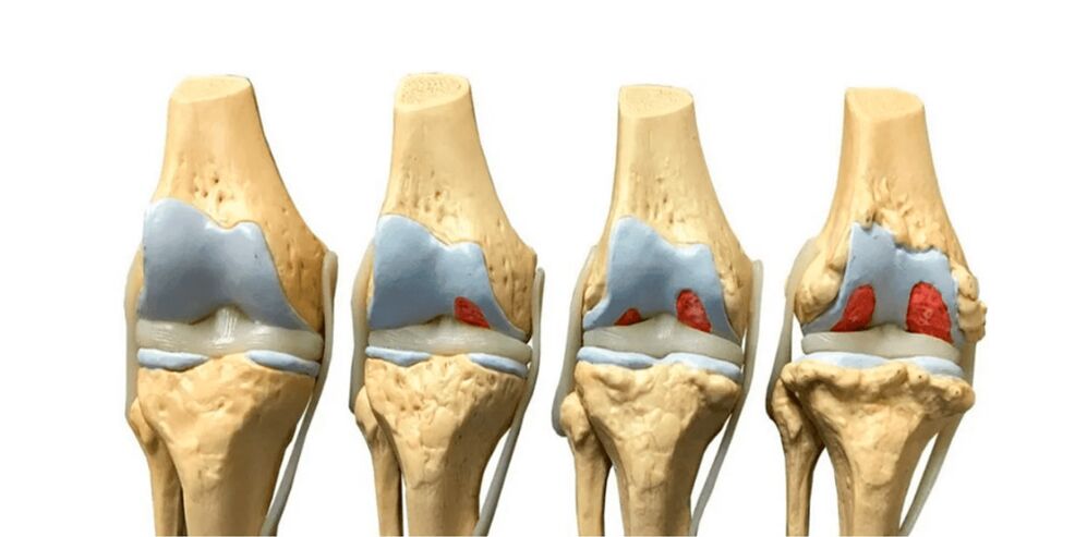 degré d'arthrose des articulations